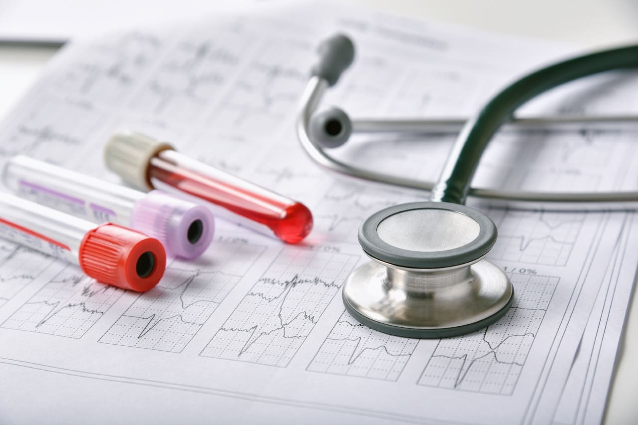 Obraz przedstawia trzy próbki krwi umieszczone na papierze wyników elektrokardiogramu. Na szczycie EKG-u znajduje się stetoskop, który jest używany do auskultacji, czyli słuchania wewnętrznych dźwięków ciała.